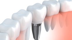 Dental Implants at Dentistry on Merivale