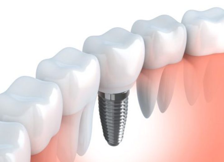 Dental Implants at Dentistry on Merivale